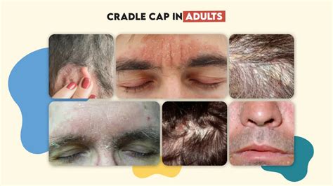 cradle cap in the elderly|cradle cap in adults treatment.